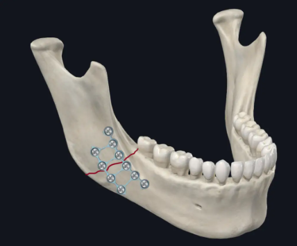 Principles of Maxillofacial Fracture Fixation: Design, Planning, and Clinical Considerations