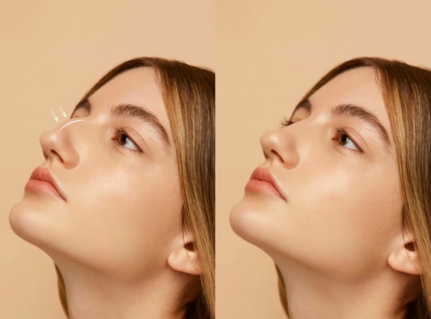 What Makes Dubai the Ideal Choice for Nose Surgery?